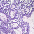 Ovarian Cyst Symptoms