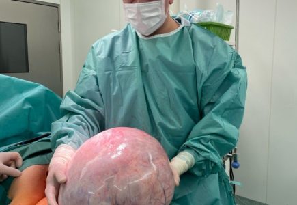 15-kilogramowy guz jajnika: przestroga, że warto robić regularne badania