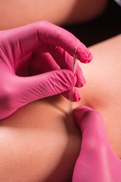 Suche igłowanie ? po co wbijać igłę, skoro i tak boli?