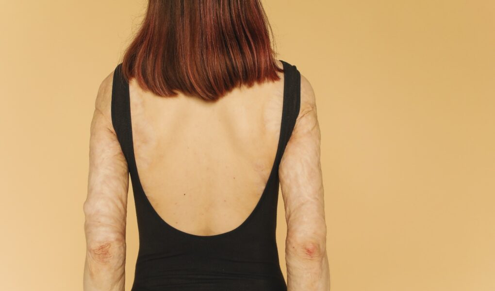 Oparzenia i trudno gojące się rany – co zrobić, gdy rana nie chce się goić?